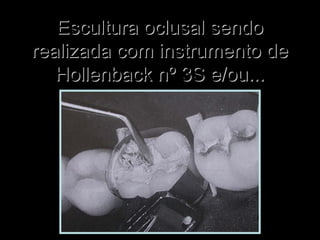Escultura oclusal sendoEscultura oclusal sendo
realizada com instrumento derealizada com instrumento de
Hollenback nº 3S e/ou...Hollenback nº 3S e/ou...
 
