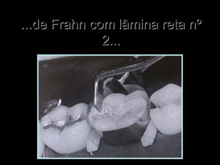 ...de Frahn com lâmina reta nº...de Frahn com lâmina reta nº
2...2...
 