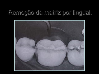 Remoção da matriz por lingual.Remoção da matriz por lingual.
 