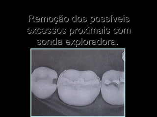Remoção dos possíveisRemoção dos possíveis
excessos proximais comexcessos proximais com
sonda exploradora.sonda exploradora.
 