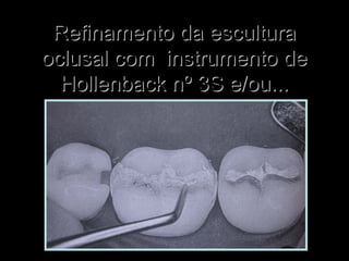 Refinamento da esculturaRefinamento da escultura
oclusal com instrumento deoclusal com instrumento de
Hollenback nº 3S e/ou...Hollenback nº 3S e/ou...
 