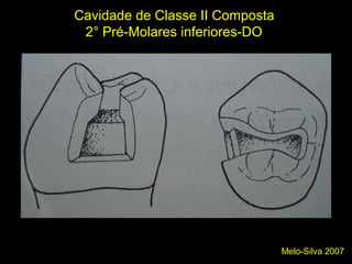 Melo-Silva 2007
Cavidade de Classe II Composta
2° Pré-Molares inferiores-DO
 