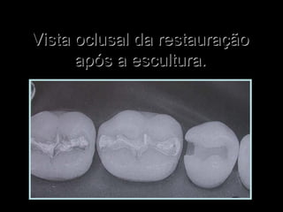 Vista oclusal da restauraçãoVista oclusal da restauração
após a escultura.após a escultura.
 