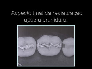 Aspecto final da restauraçãoAspecto final da restauração
após a brunidura.após a brunidura.
 