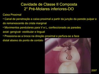 Melo-Silva 2007
Cavidade de Classe II Composta
2° Pré-Molares inferiores-DO
Caixa Proximal
• Canal de penetração a caixa proximal a partir da junção da parede pulpar e
do remanescente da crista marginal
• Movimentos pendulares para V e L, confeccionado as paredes
axial- gengival- vestibular e lingual
• Pressiona-se a broca na direção proximal e perfura-se a face
distal abaixo do ponto de contato
 