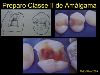 Preparo Classe II de Amálgama
Melo-Silva 2009
 