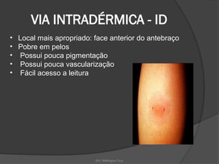 Enf. Wellington Cruz
VIA INTRADÉRMICA - ID
• Local mais apropriado: face anterior do antebraço
• Pobre em pelos
• Possui pouca pigmentação
• Possui pouca vascularização
• Fácil acesso a leitura
 