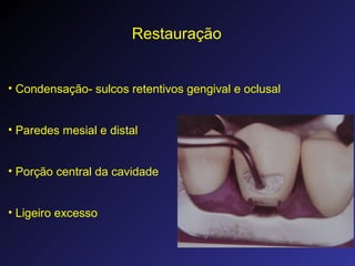 Restauração
• Condensação- sulcos retentivos gengival e oclusal
• Paredes mesial e distal
• Porção central da cavidade
• Ligeiro excesso
 