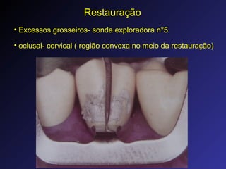 Restauração
• Excessos grosseiros- sonda exploradora n°5
• oclusal- cervical ( região convexa no meio da restauração)
 
