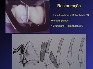 Restauração
• Escultura final – Hollenbach 3S
em dois planos
• Brunidura- Hollenbach n°6
 