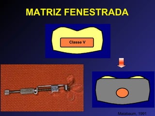 MATRIZ FENESTRADA
Maiabaum, 1991
Classe V
 
