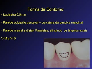 Forma de Contorno
• Lapiseira 0.5mm
• Parede oclusal e gengival – curvatura da gengiva marginal
• Parede mesial e distal- Paralelas, atingindo os ângulos axiais
V-M e V-D
 