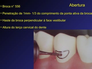 Abertura• Broca n° 556
• Penetração de 1mm- 1/3 do comprimento da ponta ativa da broca
• Haste da broca perpendicular á face vestibular
• Altura do terço cervical do dente
 