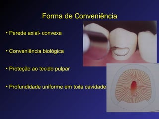 Forma de Conveniência
• Parede axial- convexa
• Conveniência biológica
• Proteção ao tecido pulpar
• Profundidade uniforme em toda cavidade
 
