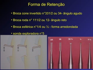 Forma de Retenção
• Broca cone invertido n°331/2 ou 34- ângulo agudo
• Broca roda n° 111/2 ou 12- ângulo reto
• Broca esfé...