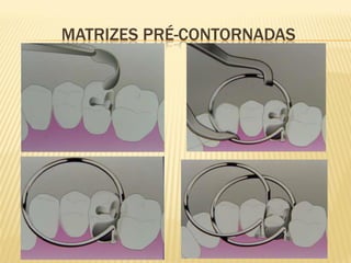 MATRIZES PRÉ-CONTORNADAS
 