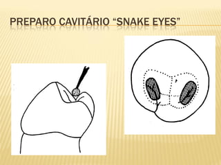 PREPARO CAVITÁRIO “SNAKE EYES”
 