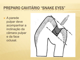 PREPARO CAVITÁRIO “SNAKE EYES”

   A parede
    pulpar deve
    acompanhar a
    inclinação da
    câmara pulpar
    e da face
    oclusal.
 