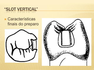 “SLOT VERTICAL”

   Características
    finais do preparo
 