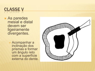 CLASSE V
   As paredes
    mesial e distal
    devem ser
    ligeiramente
    divergentes.

       Acompanhar a
        inclinação dos
        prismas e formar
        um ângulo reto
        com a superfície
        externa do dente.
 