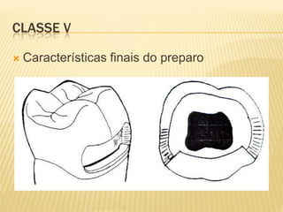 CLASSE V

   Características finais do preparo
 
