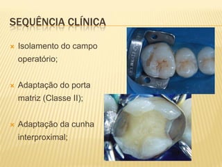 SEQUÊNCIA CLÍNICA

   Isolamento do campo
    operatório;


   Adaptação do porta
    matriz (Classe II);


   Adaptação da cunha
    interproximal;
 