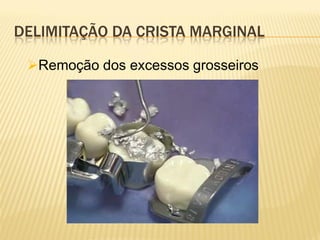 DELIMITAÇÃO DA CRISTA MARGINAL

 Remoção dos excessos grosseiros
 
