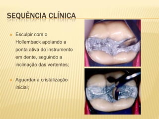 SEQUÊNCIA CLÍNICA

   Esculpir com o
    Hollemback apoiando a
    ponta ativa do instrumento
    em dente, seguindo a
    inclinação das vertentes;


   Aguardar a cristalização
    inicial;
 