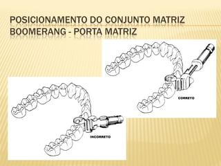 POSICIONAMENTO DO CONJUNTO MATRIZ
BOOMERANG - PORTA MATRIZ
 