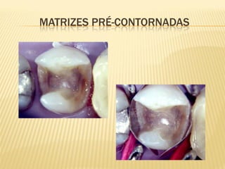 MATRIZES PRÉ-CONTORNADAS
 