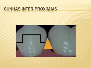 CUNHAS INTER-PROXIMAIS
 