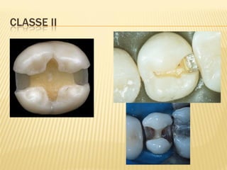CLASSE II
 