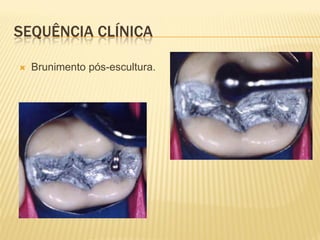 SEQUÊNCIA CLÍNICA

   Brunimento pós-escultura.
 