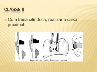 CLASSE II

   Com fresa cilíndrica, realizar a caixa
    proximal.
 