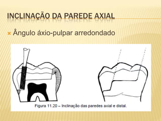 INCLINAÇÃO DA PAREDE AXIAL

   Ângulo áxio-pulpar arredondado
 