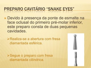 PREPARO CAVITÁRIO “SNAKE EYES”
   Devido à presença da ponte de esmalte na
    face oclusal do primeiro pré-molar inferior,
    este preparo consta de duas pequenas
    cavidades.
    Realiza-se a abertura com fresa
     diamantada esférica.


    Segue o preparo com fresa
     diamantada cilíndrica.
 
