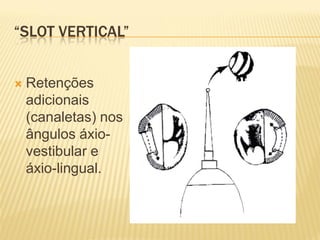 “SLOT VERTICAL”


   Retenções
    adicionais
    (canaletas) nos
    ângulos áxio-
    vestibular e
    áxio-lingual.
 