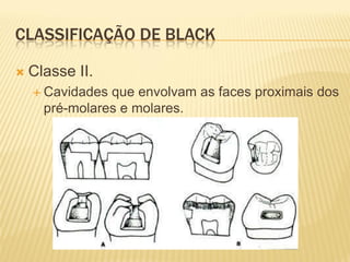 CLASSIFICAÇÃO DE BLACK

   Classe II.
     Cavidades que envolvam as faces proximais dos
      pré-molares e molares.
 