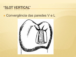 “SLOT VERTICAL”

   Convergência das paredes V e L
 