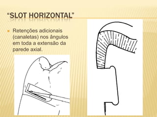 “SLOT HORIZONTAL”
   Retenções adicionais
    (canaletas) nos ângulos
    em toda a extensão da
    parede axial.
 