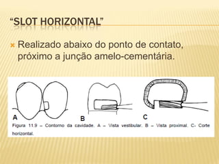 “SLOT HORIZONTAL”

   Realizado abaixo do ponto de contato,
    próximo a junção amelo-cementária.
 