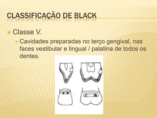 CLASSIFICAÇÃO DE BLACK

   Classe V.
     Cavidades   preparadas no terço gengival, nas
      faces vestibular e lingual / palatina de todos os
      dentes.
 