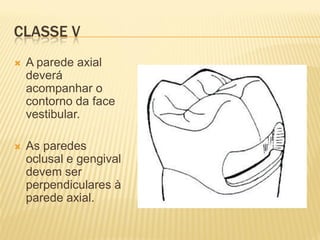 CLASSE V
   A parede axial
    deverá
    acompanhar o
    contorno da face
    vestibular.

   As paredes
    oclusal e gengival
    devem ser
    perpendiculares à
    parede axial.
 