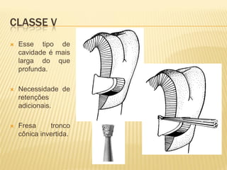 CLASSE V
   Esse tipo de
    cavidade é mais
    larga do que
    profunda.

   Necessidade de
    retenções
    adicionais.

   Fresa     tronco
    cônica invertida.
 