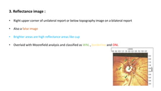 3. Reflectance image :
• Right upper corner of unilateral report or below topography image on a bilateral report
• Also a false image
• Brighter areas are high reflectance areas like cup
• Overlaid with Moorefield analysis and classified as WNL , borderline and ONL
 