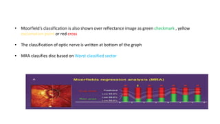 • Moorfield's classification is also shown over reflectance image as green checkmark , yellow
exclamation point or red cross
• The classification of optic nerve is written at bottom of the graph
• MRA classifies disc based on Worst classified sector
 