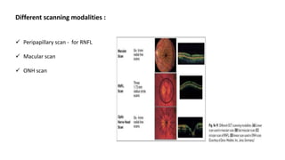 Different scanning modalities :
 Peripapillary scan - for RNFL
 Macular scan
 ONH scan
 