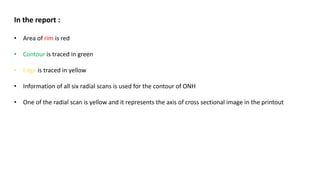 In the report :
• Area of rim is red
• Contour is traced in green
• Edge is traced in yellow
• Information of all six radial scans is used for the contour of ONH
• One of the radial scan is yellow and it represents the axis of cross sectional image in the printout
 
