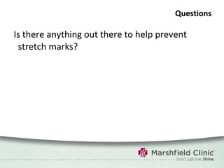 Questions Is there anything out there to help prevent stretch marks? 