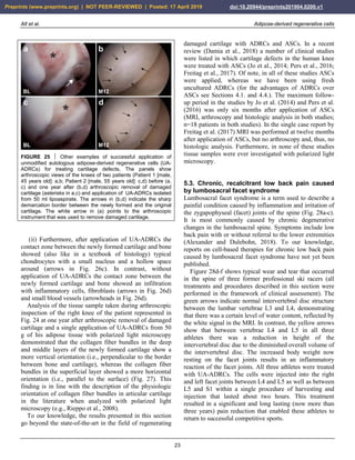 Alt et al. Adipose-derived regenerative cells
23
FIGURE 25  Other examples of successful application of
unmodified autologous adipose-derived regenerative cells (UA-
ADRCs) for treating cartilage defects. The panels show
arthroscopic views of the knees of two patients (Patient 1 [male,
45 years old]: a,b; Patient 2 [male, 55 years old]: c,d) before (a,
c) and one year after (b,d) arthroscopic removal of damaged
cartilage (asterisks in a,c) and application of UA-ADRCs isolated
from 50 ml lipoaspirate. The arrows in (b,d) indicate the sharp
demarcation border between the newly formed and the original
cartilage. The white arrow in (a) points to the arthroscopic
instrument that was used to remove damaged cartilage.
(ii) Furthermore, after application of UA-ADRCs the
contact zone between the newly formed cartilage and bone
showed (also like in a textbook of histology) typical
chondrocytes with a small nucleus and a hollow space
around (arrows in Fig. 26c). In contrast, without
application of UA-ADRCs the contact zone between the
newly formed cartilage and bone showed an infiltration
with inflammatory cells, fibroblasts (arrows in Fig. 26d)
and small blood vessels (arrowheads in Fig. 26d).
Analysis of the tissue sample taken during arthroscopic
inspection of the right knee of the patient represented in
Fig. 24 at one year after arthroscopic removal of damaged
cartilage and a single application of UA-ADRCs from 50
g of his adipose tissue with polarized light microscopy
demonstrated that the collagen fiber bundles in the deep
and middle layers of the newly formed cartilage show a
more vertical orientation (i.e., perpendicular to the border
between bone and cartilage), whereas the collagen fiber
bundles in the superficial layer showed a more horizontal
orientation (i.e., parallel to the surface) (Fig. 27). This
finding is in line with the description of the physiologic
orientation of collagen fiber bundles in articular cartilage
in the literature when analyzed with polarized light
microscopy (e.g., Rieppo et al., 2008).
To our knowledge, the results presented in this section
go beyond the state-of-the-art in the field of regenerating
damaged cartilage with ADRCs and ASCs. In a recent
review (Damia et al., 2018) a number of clinical studies
were listed in which cartilage defects in the human knee
were treated with ASCs (Jo et al., 2014; Pers et al., 2016;
Freitag et al., 2017). Of note, in all of these studies ASCs
were applied, whereas we have been using fresh
uncultured ADRCs (for the advantages of ADRCs over
ASCs see Sections 4.1. and 4.4.). The maximum follow-
up period in the studies by Jo et al. (2014) and Pers et al.
(2016) was only six months after application of ASCs
(MRI, arthroscopy and histologic analysis in both studies;
n=18 patients in both studies). In the single case report by
Freitag et al. (2017) MRI was performed at twelve months
after application of ASCs, but no arthroscopy and, thus, no
histologic analysis. Furthermore, in none of these studies
tissue samples were ever investigated with polarized light
microscopy.
5.3. Chronic, recalcitrant low back pain caused
by lumbosacral facet syndrome
Lumbosacral facet syndrome is a term used to describe a
painful condition caused by inflammation and irritation of
the zygapophyseal (facet) joints of the spine (Fig. 28a-c).
It is most commonly caused by chronic degenerative
changes in the lumbosacral spine. Symptoms include low
back pain with or without referral to the lower extremities
(Alexander and Dulebohn, 2018). To our knowledge,
reports on cell-based therapies for chronic low back pain
caused by lumbosacral facet syndrome have not yet been
published.
Figure 28d-f shows typical wear and tear that occurred
in the spine of three former professional ski racers (all
treatments and procedures described in this section were
performed in the framework of clinical assessment). The
green arrows indicate normal intervertebral disc structure
between the lumbar vertebrae L3 and L4, demonstrating
that there was a certain level of water content, reflected by
the white signal in the MRI. In contrast, the yellow arrows
show that between vertebrae L4 and L5 in all three
athletes there was a reduction in height of the
intervertebral disc due to the diminished overall volume of
the intervertebral disc. The increased body weight now
resting on the facet joints results in an inflammatory
reaction of the facet joints. All three athletes were treated
with UA-ADRCs. The cells were injected into the right
and left facet joints between L4 and L5 as well as between
L5 and S1 within a single procedure of harvesting and
injection that lasted about two hours. This treatment
resulted in a significant and long lasting (now more than
three years) pain reduction that enabled these athletes to
return to successful competitive sports.
Preprints (www.preprints.org) | NOT PEER-REVIEWED | Posted: 17 April 2019 doi:10.20944/preprints201904.0200.v1
 